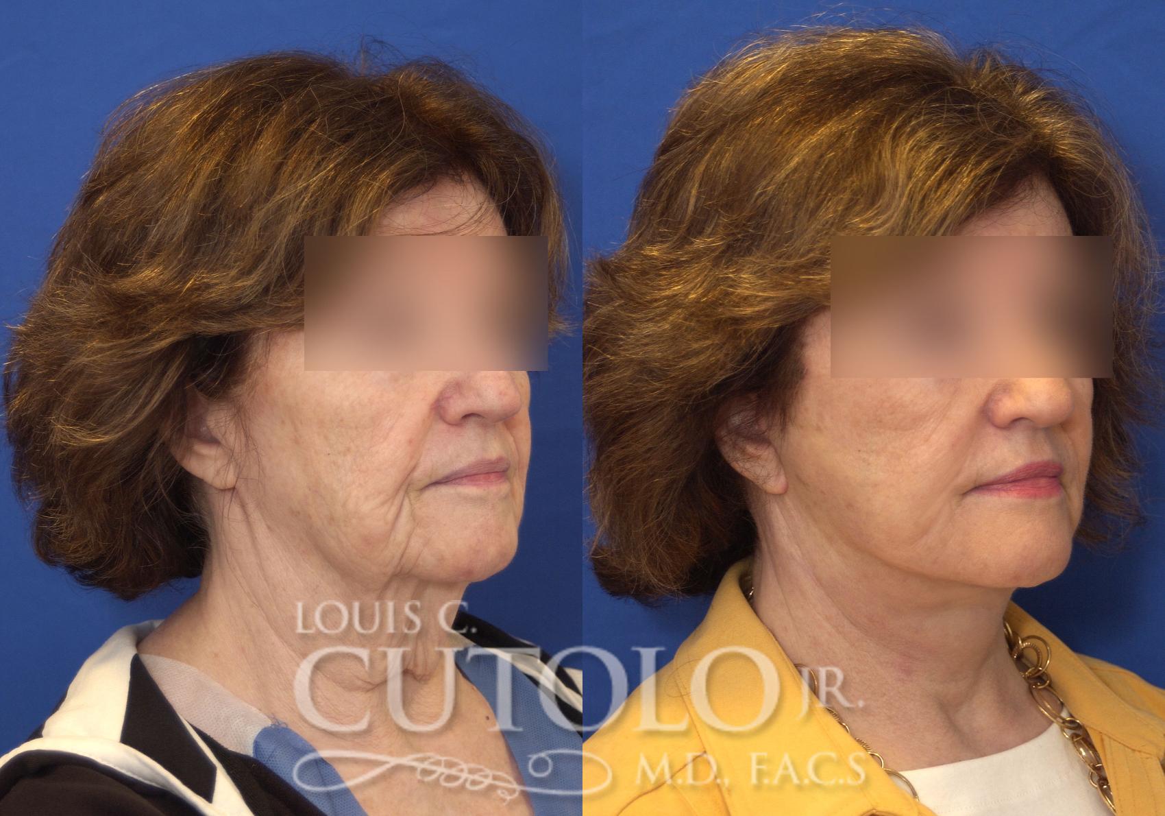 Before & After Rejuvelift™ - Mini Lift Case 166 View #4 View in Brooklyn, Staten Island, Queens, NY