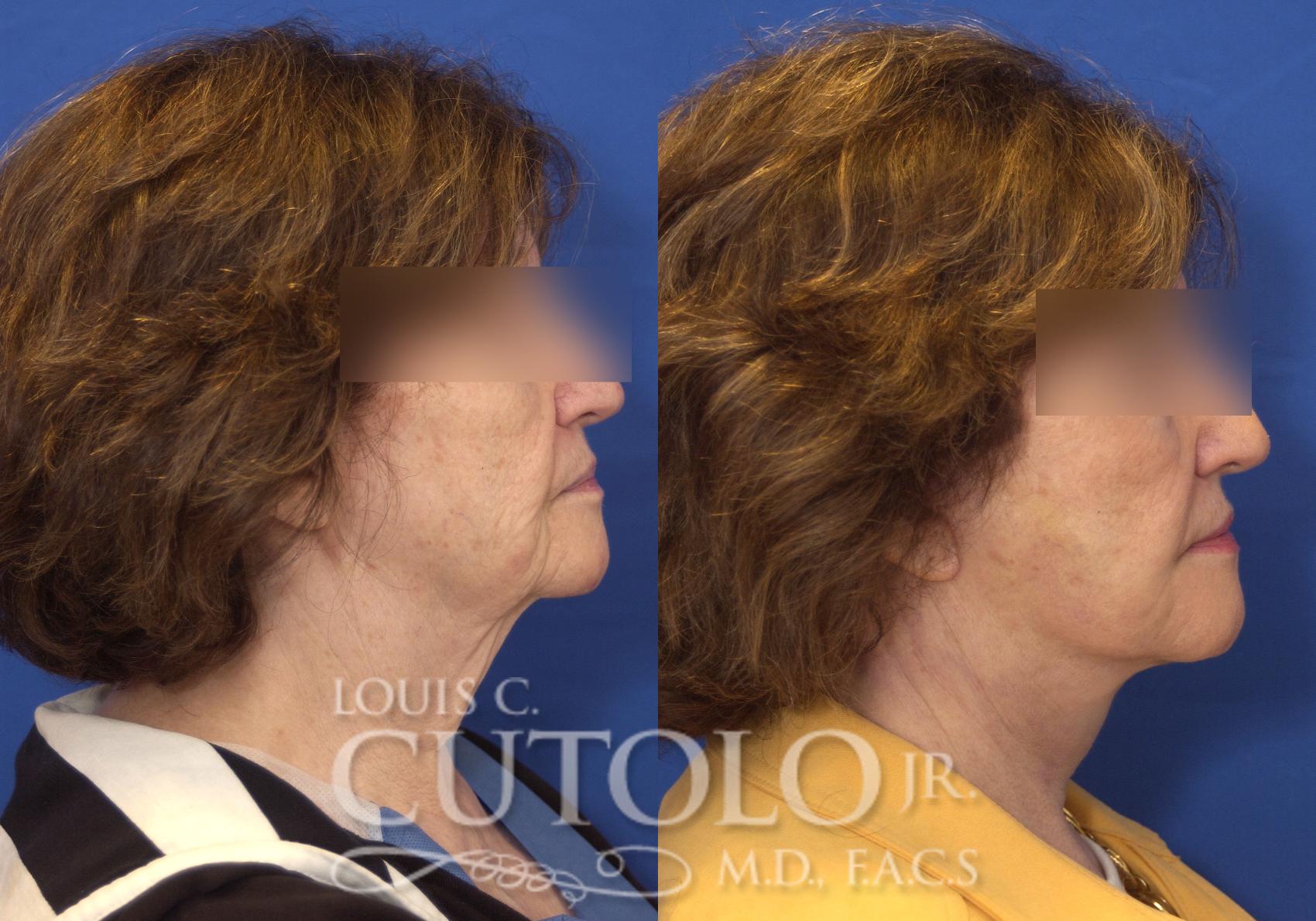 Before & After Rejuvelift™ - Mini Lift Case 166 View #5 View in Brooklyn, Staten Island, Queens, NY