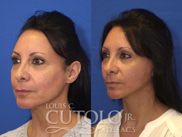 Before & After Rejuvelift™ Case 170 View #2 View in Brooklyn, Staten Island, Queens, NY