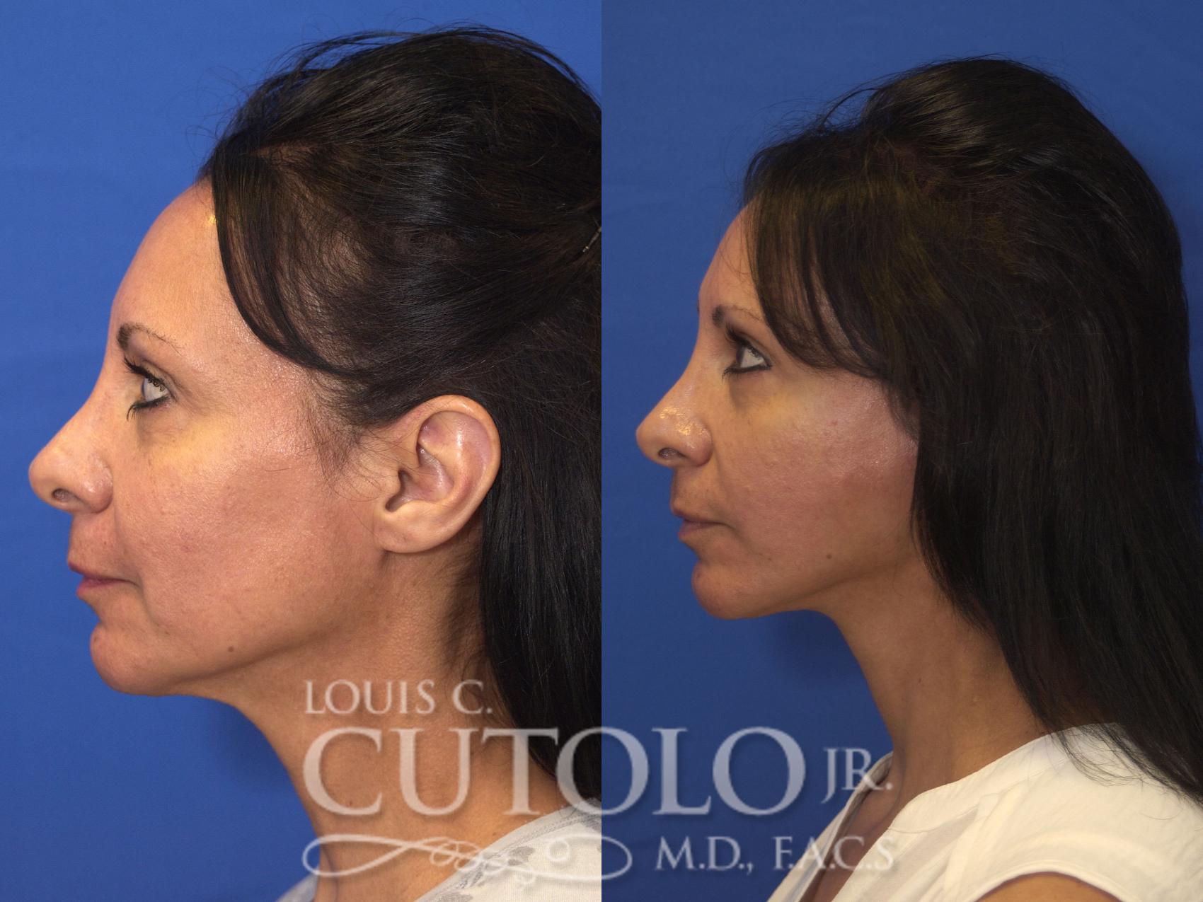 Before & After Rejuvelift™ - Mini Lift Case 170 View #3 View in Brooklyn, Staten Island, Queens, NY