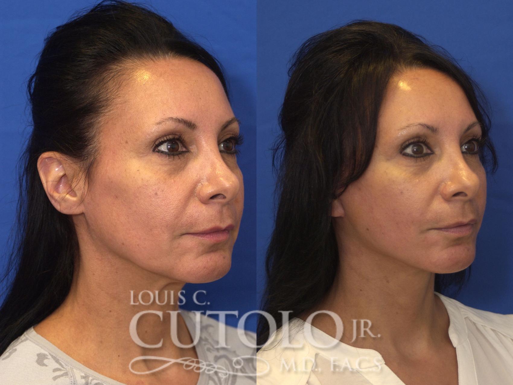 Before & After Rejuvelift™ - Mini Lift Case 170 View #4 View in Brooklyn, Staten Island, Queens, NY
