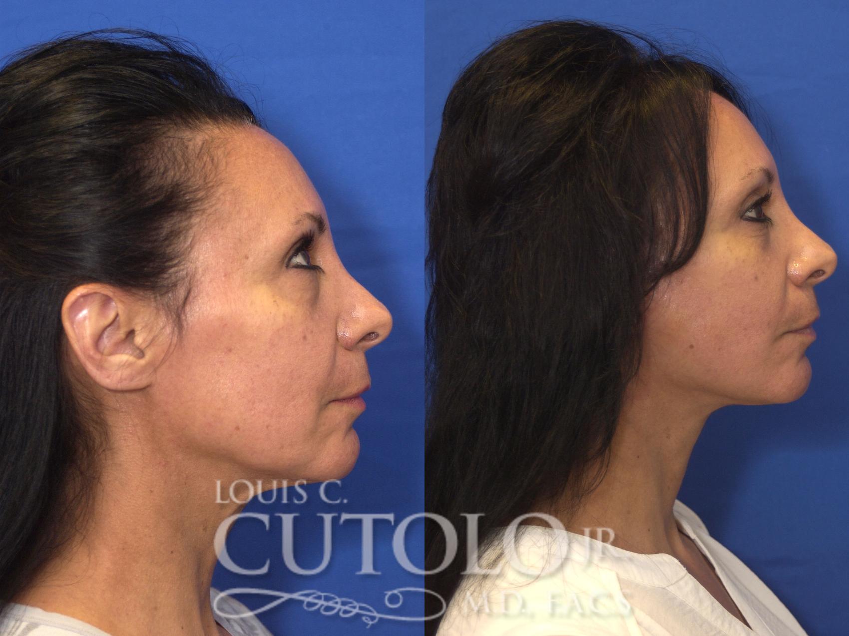 Before & After Rejuvelift™ - Mini Lift Case 170 View #5 View in Brooklyn, Staten Island, Queens, NY