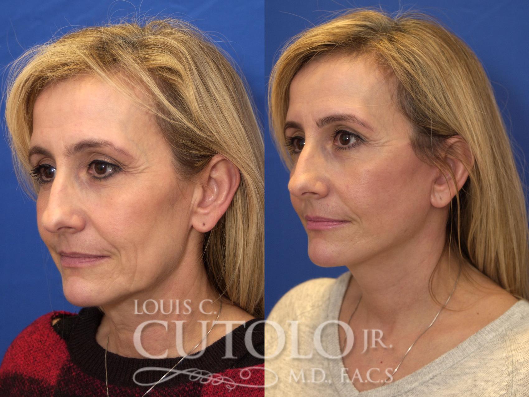 Before & After Rejuvelift™ - Mini Lift Case 180 View #2 View in Brooklyn, Staten Island, Queens, NY