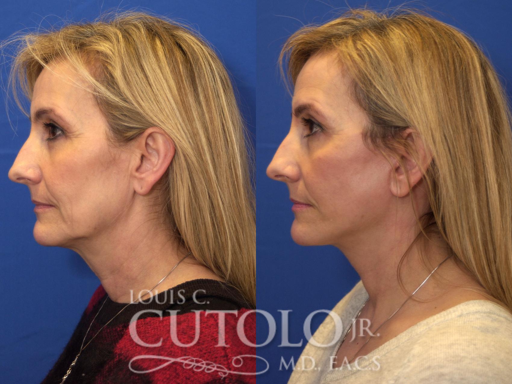 Before & After Rejuvelift™ - Mini Lift Case 180 View #3 View in Brooklyn, Staten Island, Queens, NY