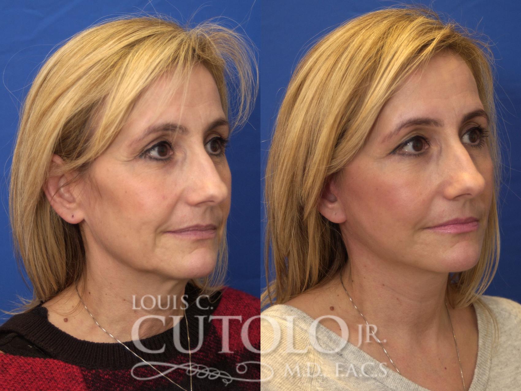 Before & After Rejuvelift™ - Mini Lift Case 180 View #4 View in Brooklyn, Staten Island, Queens, NY
