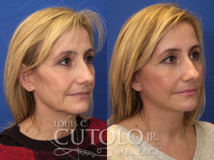 Before & After Rejuvelift™ Case 180 View #4 View in Brooklyn, Staten Island, Queens, NY