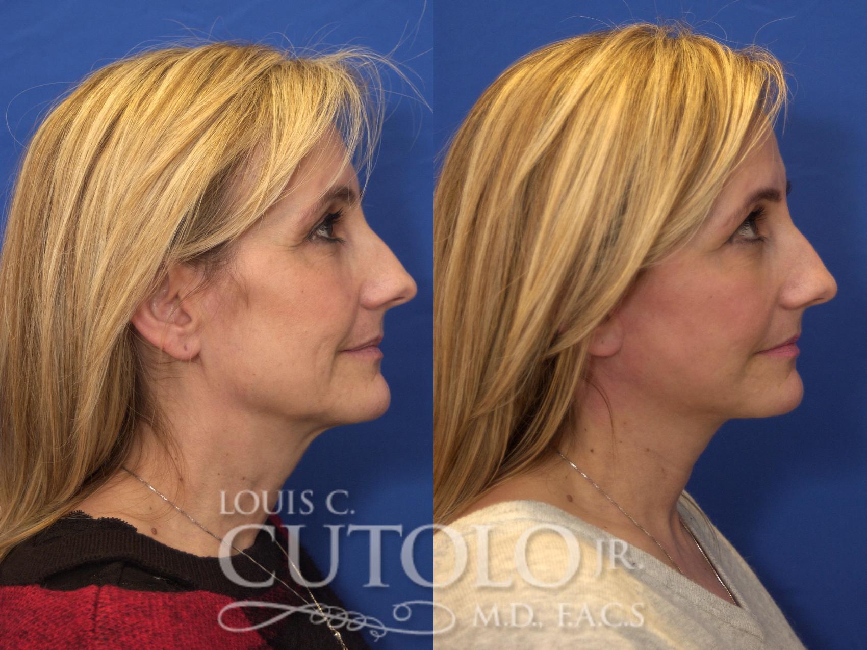 Before & After Rejuvelift™ - Mini Lift Case 180 View #5 View in Brooklyn, Staten Island, Queens, NY