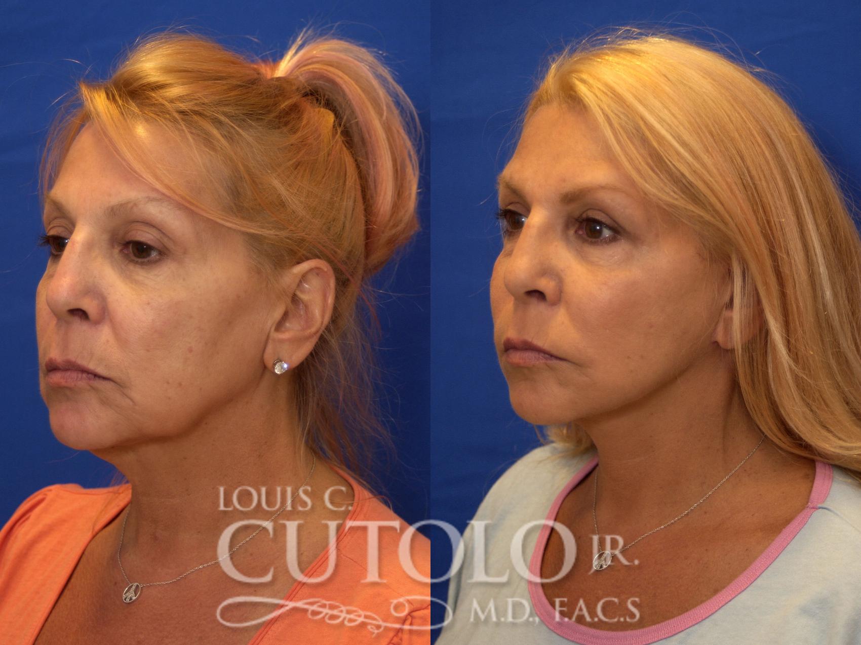 Before & After Rejuvelift™ - Mini Lift Case 184 View #2 View in Brooklyn, Staten Island, Queens, NY