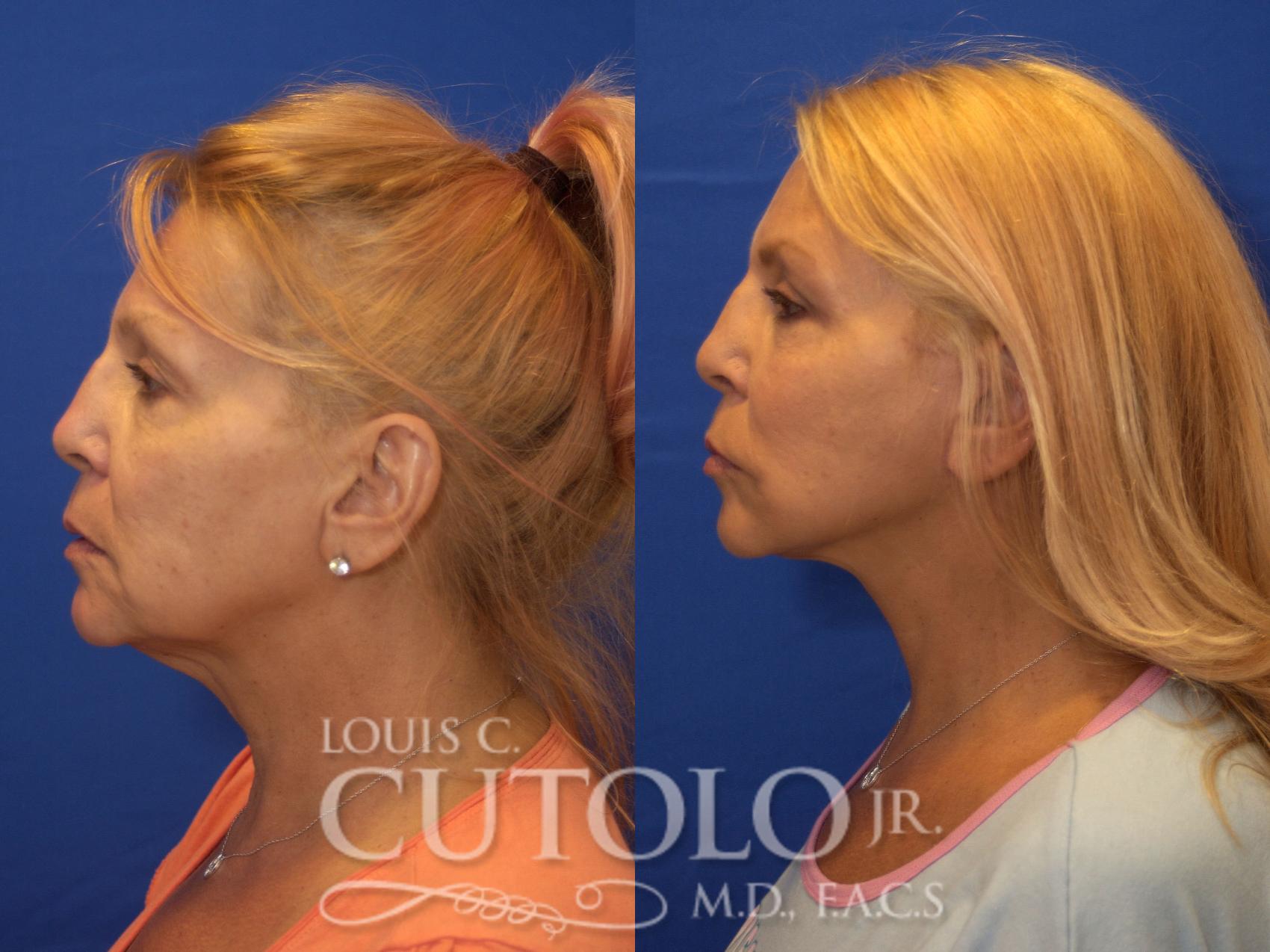 Before & After Rejuvelift™ - Mini Lift Case 184 View #3 View in Brooklyn, Staten Island, Queens, NY