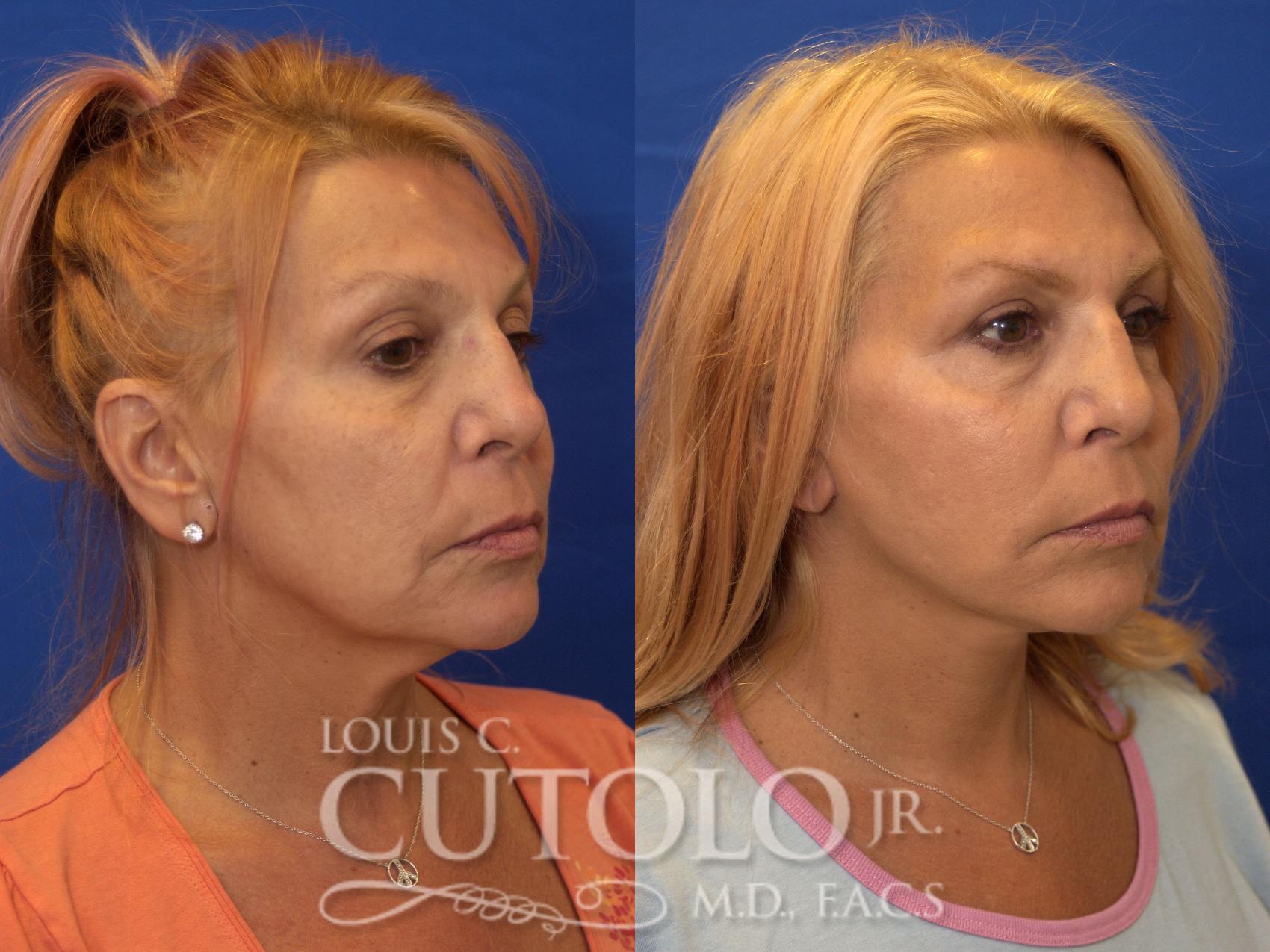 Before & After Rejuvelift™ - Mini Lift Case 184 View #4 View in Brooklyn, Staten Island, Queens, NY