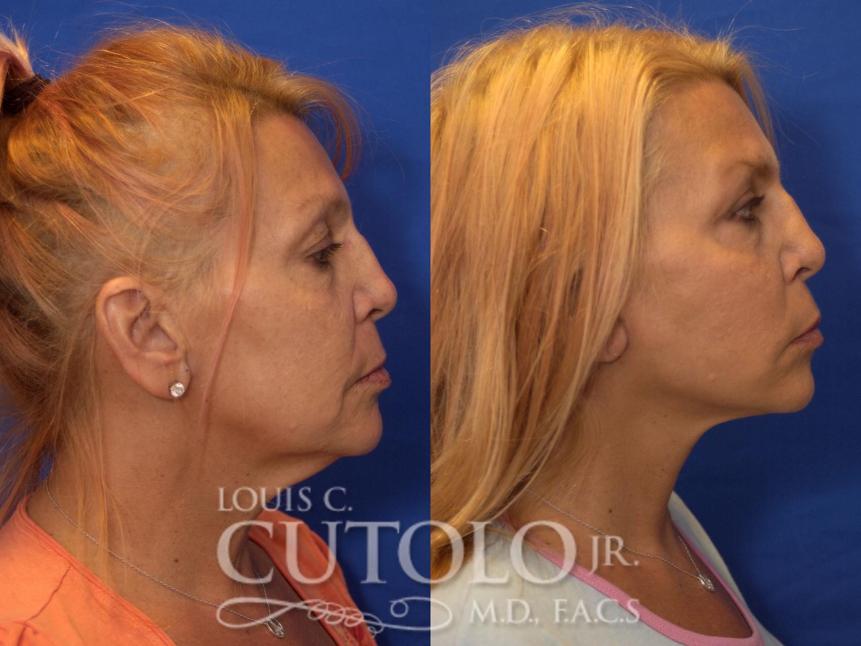 Before & After Rejuvelift™ - Mini Lift Case 184 View #5 View in Brooklyn, Staten Island, Queens, NY