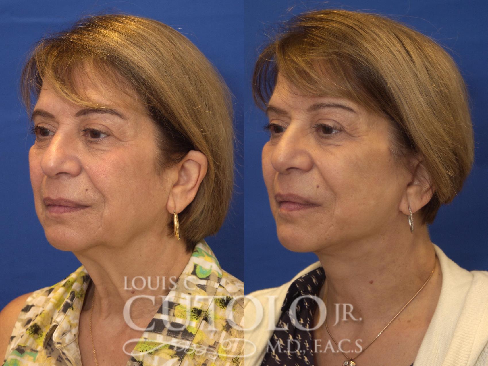 Before & After Rejuvelift™ - Mini Lift Case 197 View #2 View in Brooklyn, Staten Island, Queens, NY