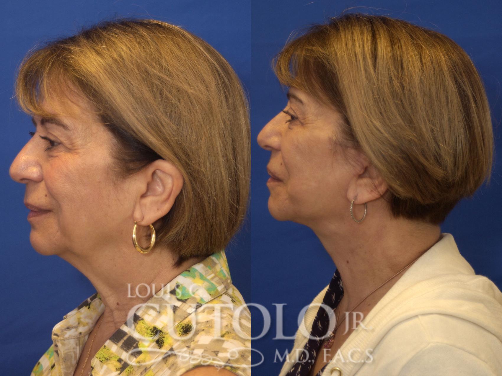 Before & After Rejuvelift™ - Mini Lift Case 197 View #3 View in Brooklyn, Staten Island, Queens, NY