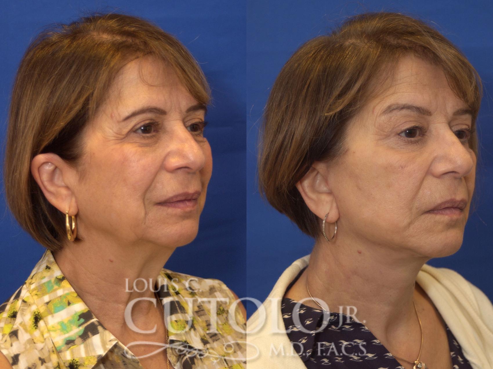 Before & After Rejuvelift™ - Mini Lift Case 197 View #4 View in Brooklyn, Staten Island, Queens, NY