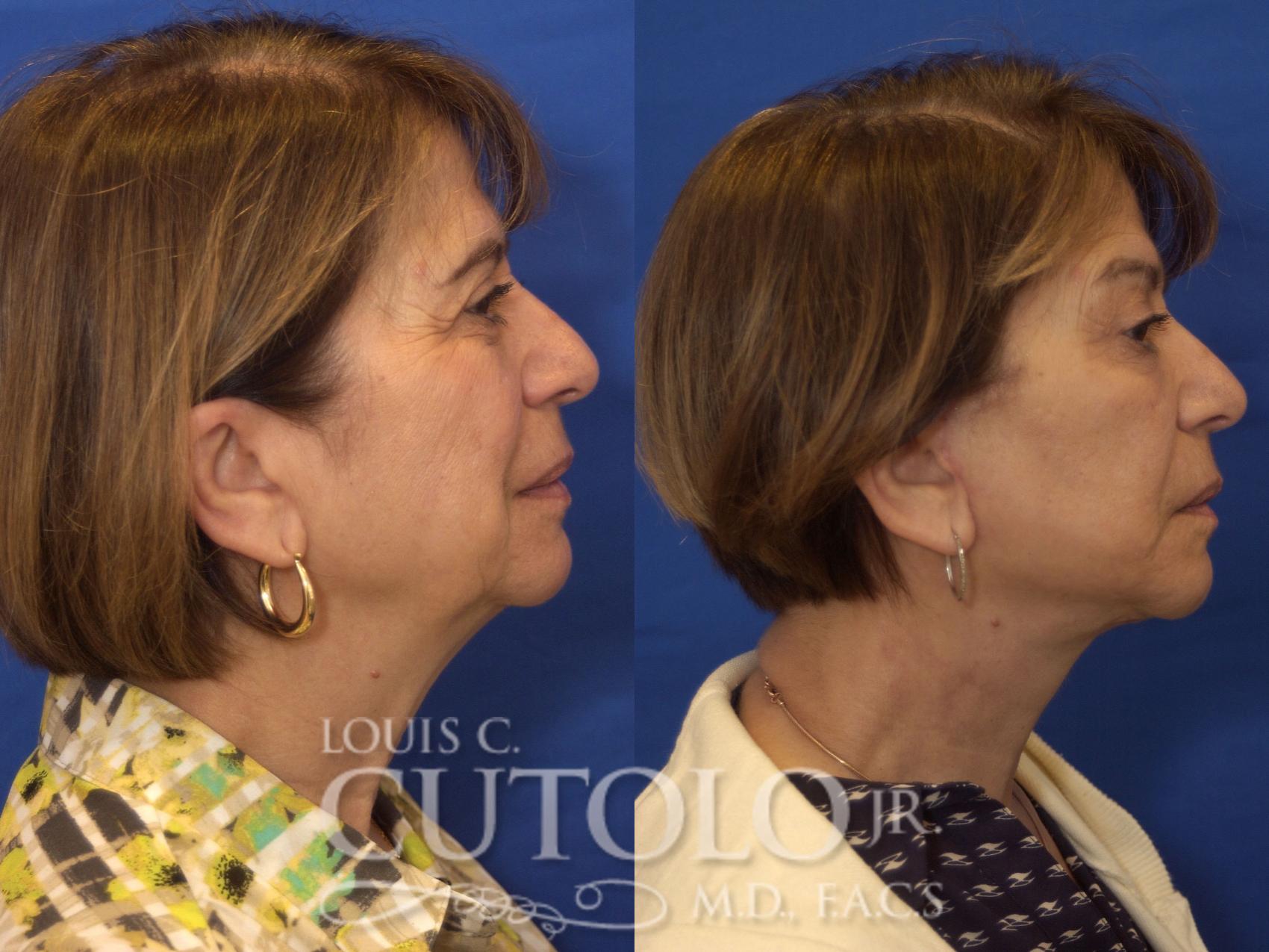 Before & After Rejuvelift™ - Mini Lift Case 197 View #5 View in Brooklyn, Staten Island, Queens, NY
