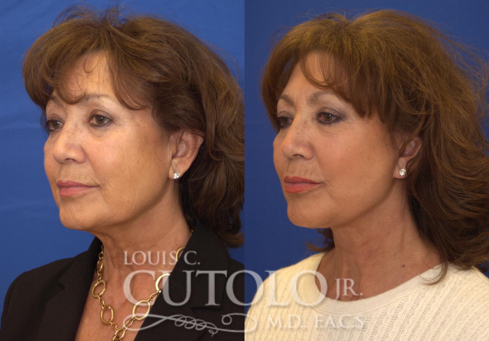 Before & After Rejuvelift™ - Mini Lift Case 200 View #2 View in Brooklyn, Staten Island, Queens, NY