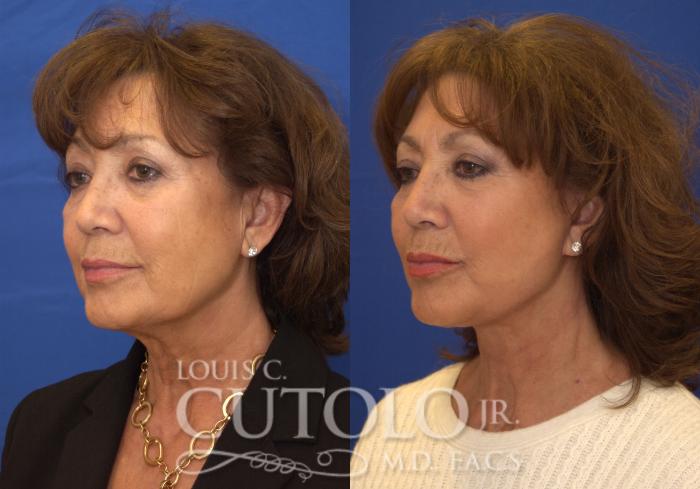 Before & After Rejuvelift™ Case 200 View #2 View in Brooklyn, Staten Island, Queens, NY