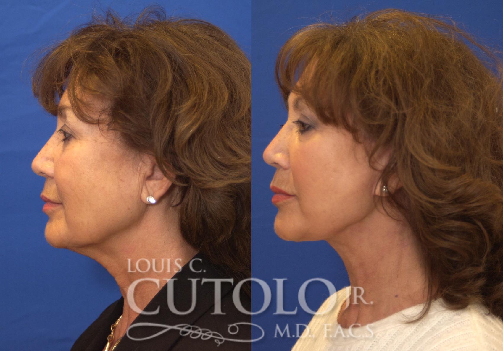 Before & After Rejuvelift™ - Mini Lift Case 200 View #3 View in Brooklyn, Staten Island, Queens, NY