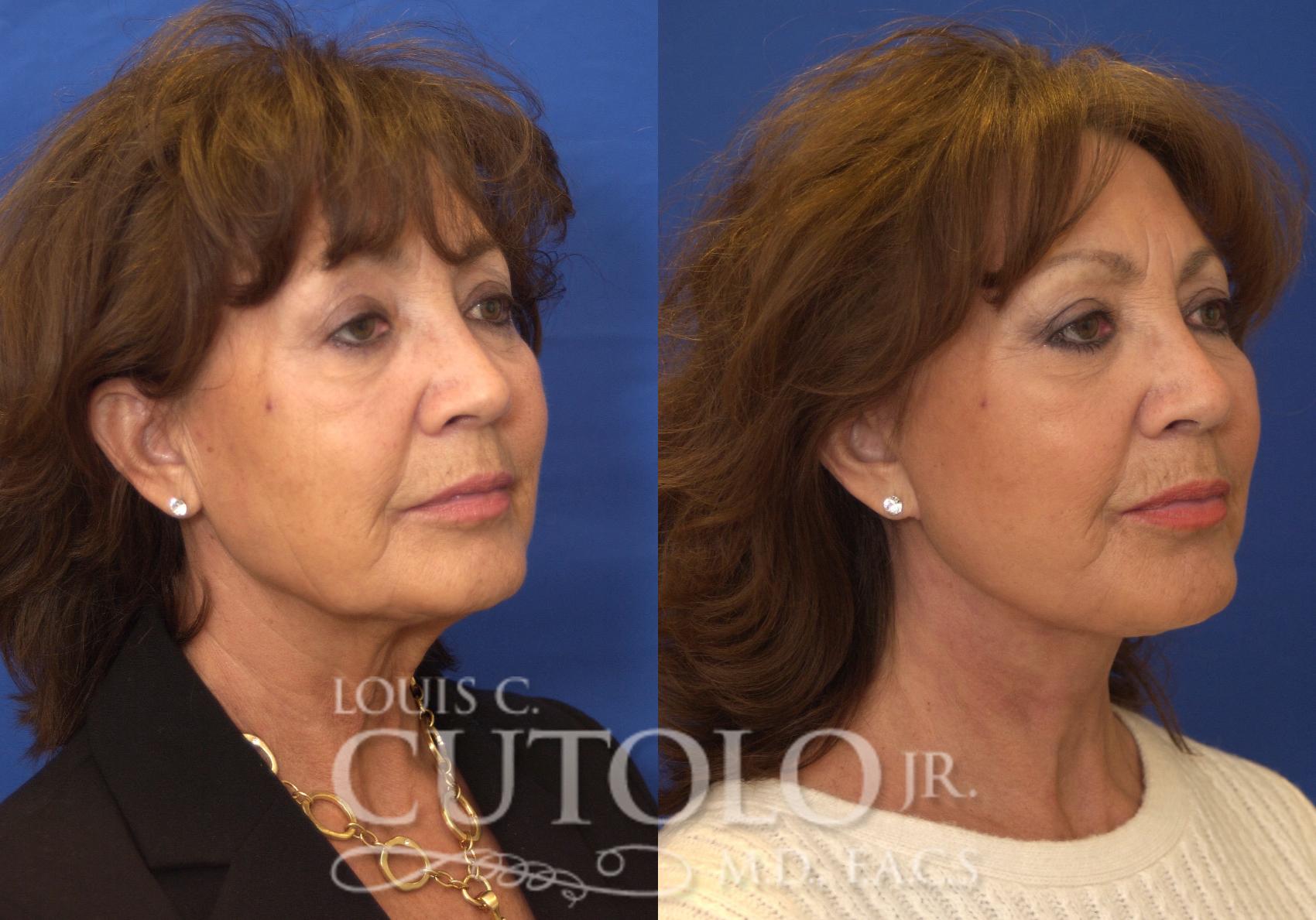 Before & After Rejuvelift™ - Mini Lift Case 200 View #4 View in Brooklyn, Staten Island, Queens, NY