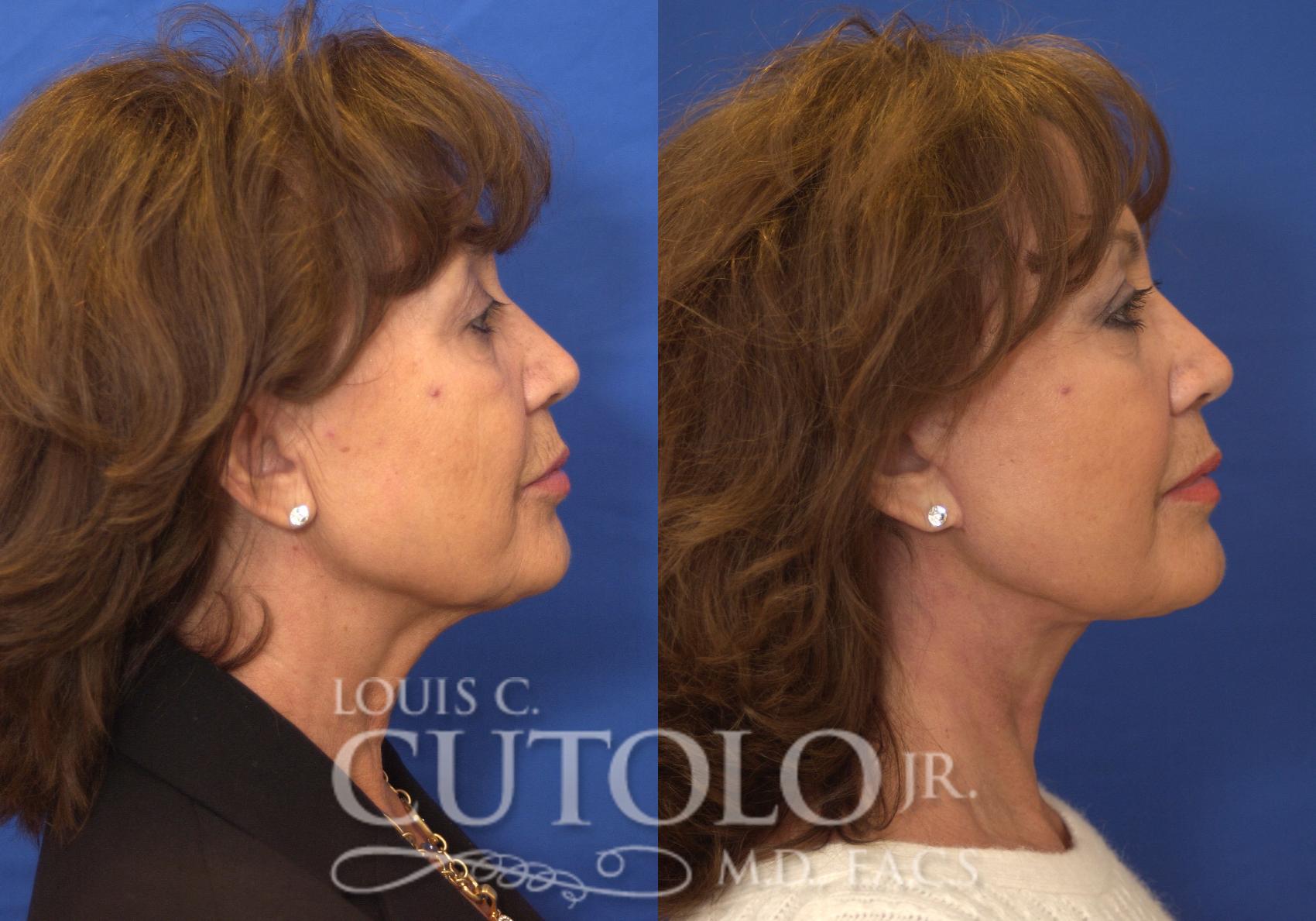 Before & After Rejuvelift™ - Mini Lift Case 200 View #5 View in Brooklyn, Staten Island, Queens, NY