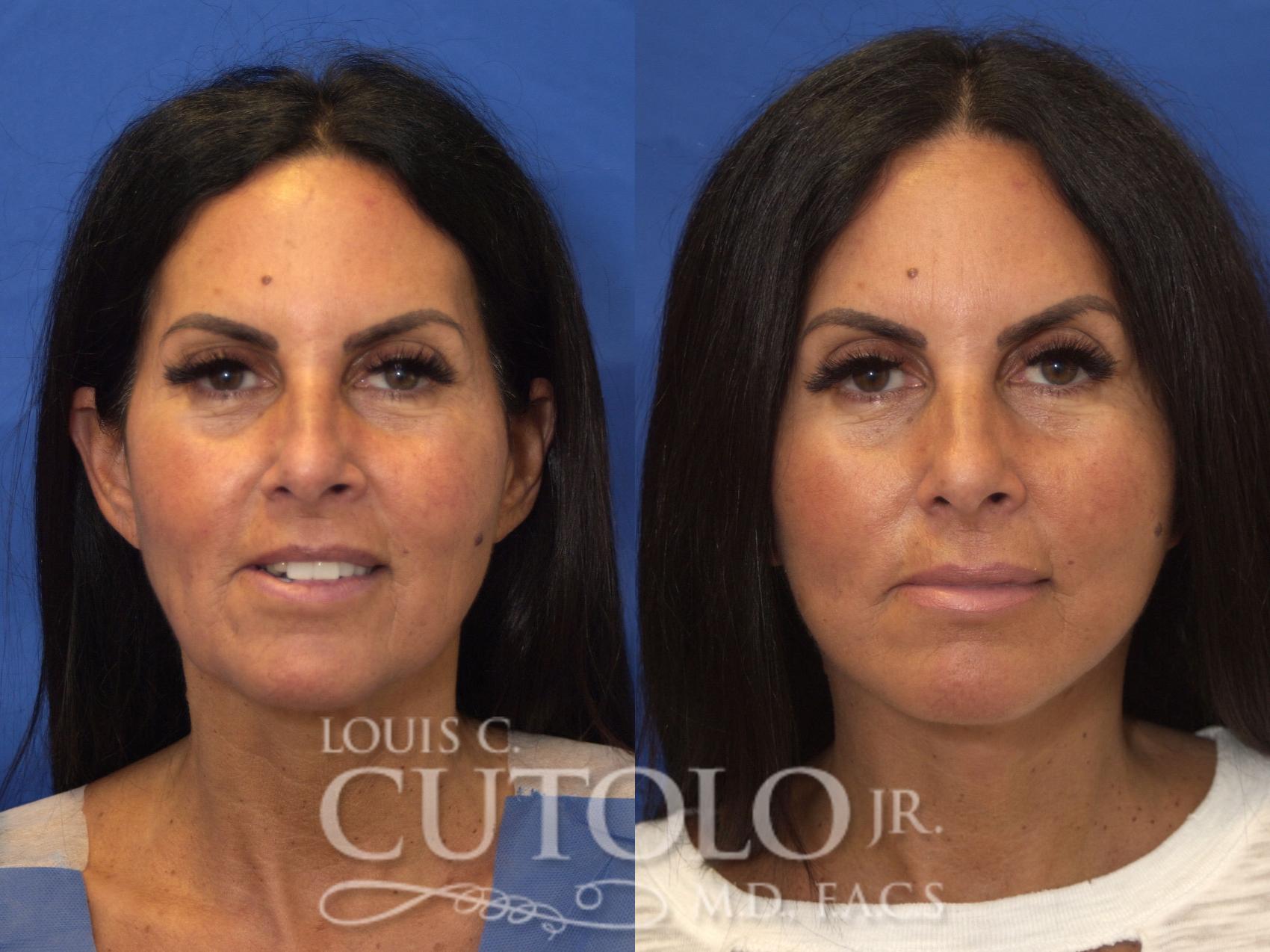 Before & After Rejuvelift™ Case 203 View #1 View in Brooklyn, Staten Island, Queens, NY