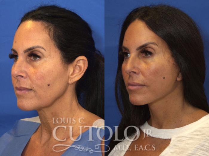 Before & After Rejuvelift™ Case 203 View #2 View in Brooklyn, Staten Island, Queens, NY
