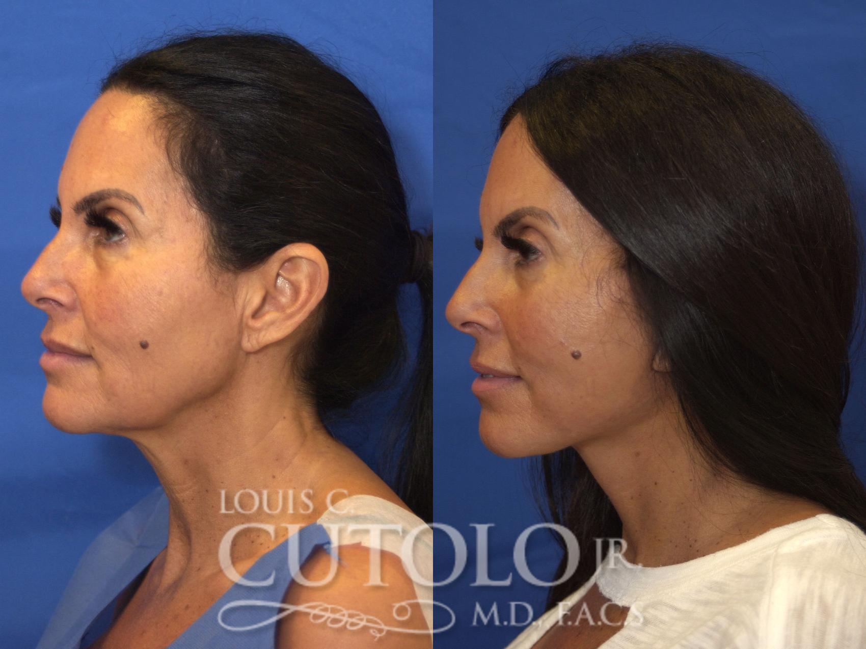 Before & After Rejuvelift™ - Mini Lift Case 203 View #3 View in Brooklyn, Staten Island, Queens, NY