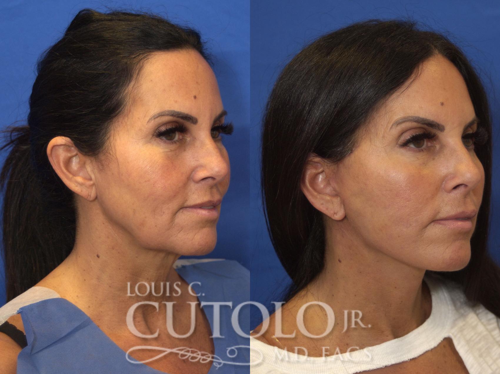 Before & After Rejuvelift™ - Mini Lift Case 203 View #4 View in Brooklyn, Staten Island, Queens, NY