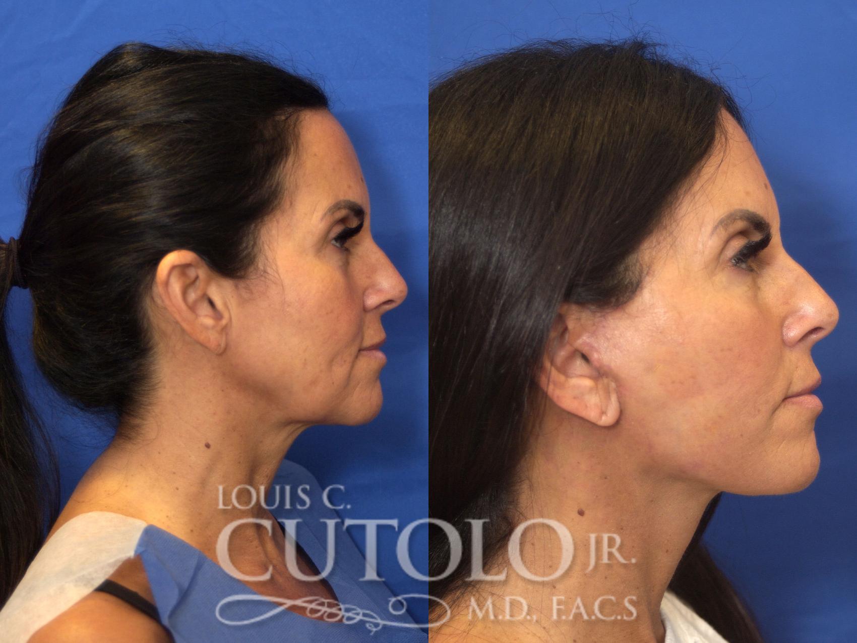 Before & After Rejuvelift™ - Mini Lift Case 203 View #5 View in Brooklyn, Staten Island, Queens, NY