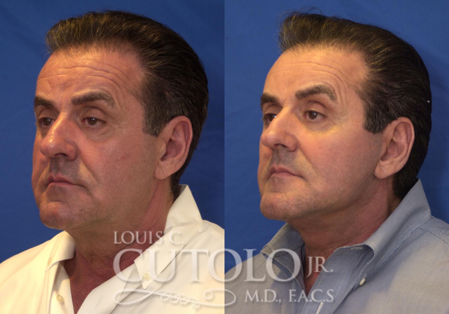 Before & After Rejuvelift™ - Mini Lift Case 210 View #2 View in Brooklyn, Staten Island, Queens, NY