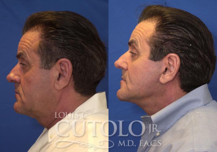 Before & After Rejuvelift™ Case 210 View #3 View in Brooklyn, Staten Island, Queens, NY