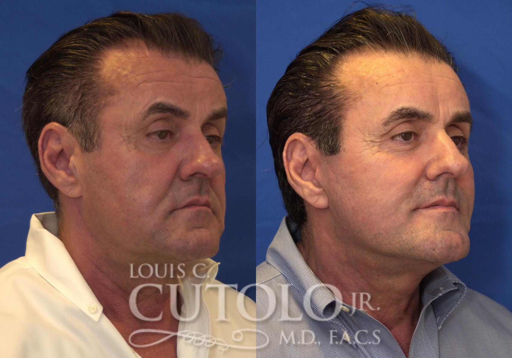 Before & After Rejuvelift™ - Mini Lift Case 210 View #4 View in Brooklyn, Staten Island, Queens, NY