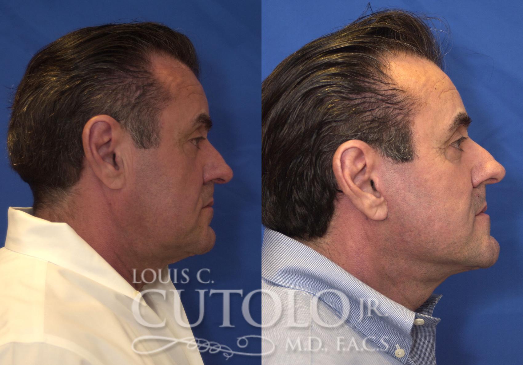 Before & After Rejuvelift™ - Mini Lift Case 210 View #5 View in Brooklyn, Staten Island, Queens, NY