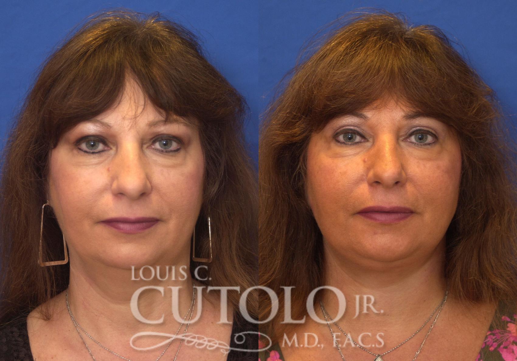 Before & After Rejuvelift™ Case 212 View #1 View in Brooklyn, Staten Island, Queens, NY