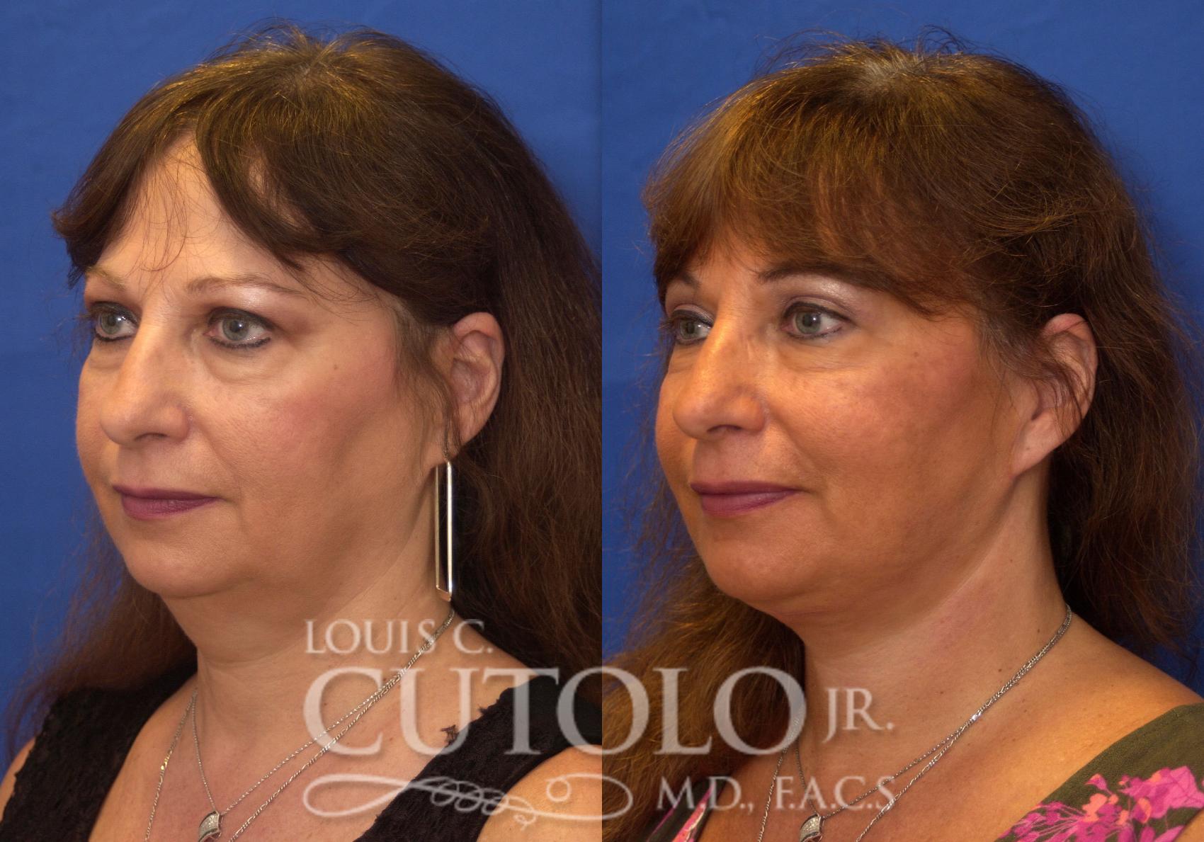 Before & After Rejuvelift™ - Mini Lift Case 212 View #2 View in Brooklyn, Staten Island, Queens, NY