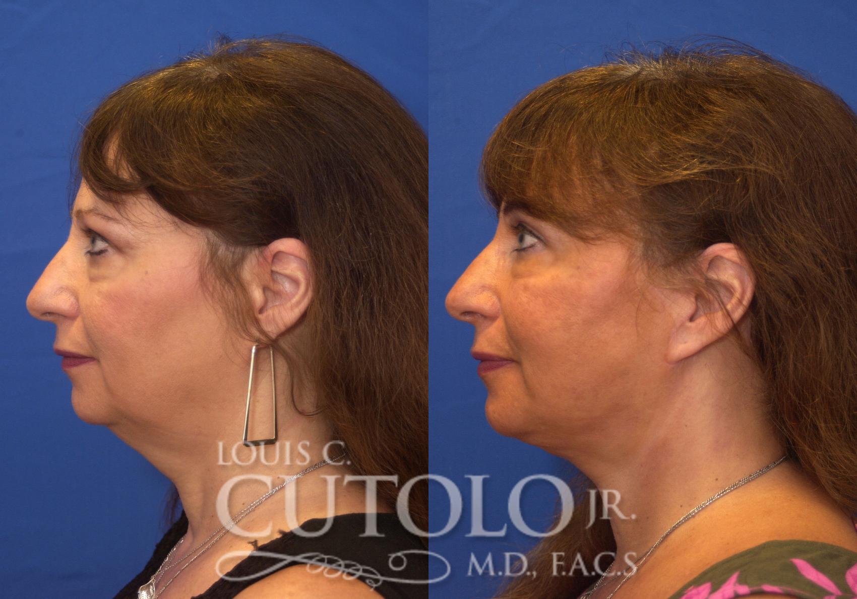 Before & After Rejuvelift™ - Mini Lift Case 212 View #3 View in Brooklyn, Staten Island, Queens, NY