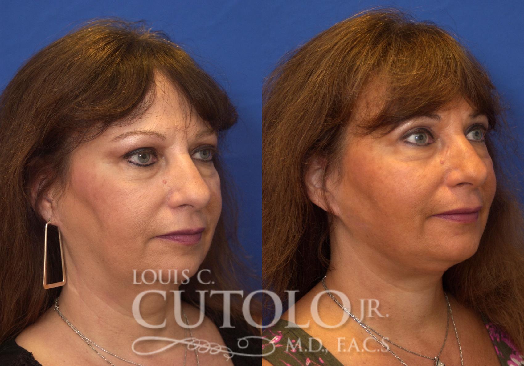 Before & After Rejuvelift™ - Mini Lift Case 212 View #4 View in Brooklyn, Staten Island, Queens, NY