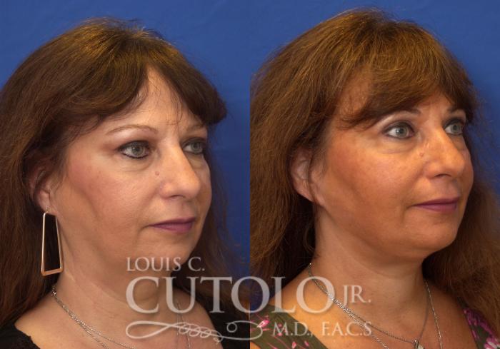 Before & After Rejuvelift™ Case 212 View #4 View in Brooklyn, Staten Island, Queens, NY