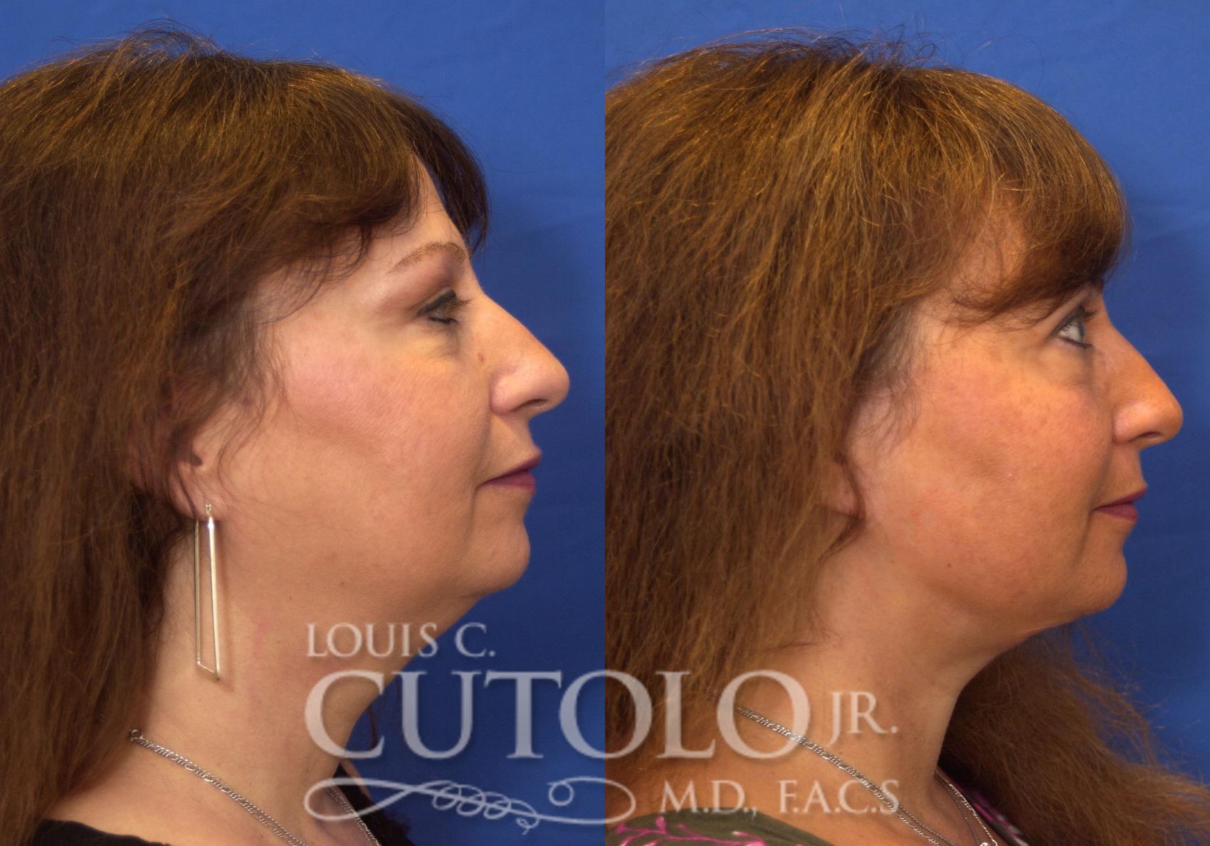 Before & After Rejuvelift™ - Mini Lift Case 212 View #5 View in Brooklyn, Staten Island, Queens, NY