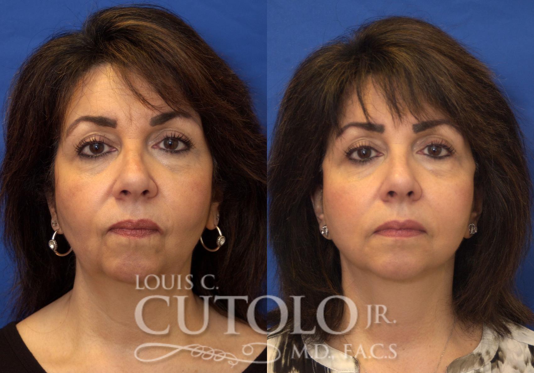 Before & After Rejuvelift™ Case 215 View #1 View in Brooklyn, Staten Island, Queens, NY