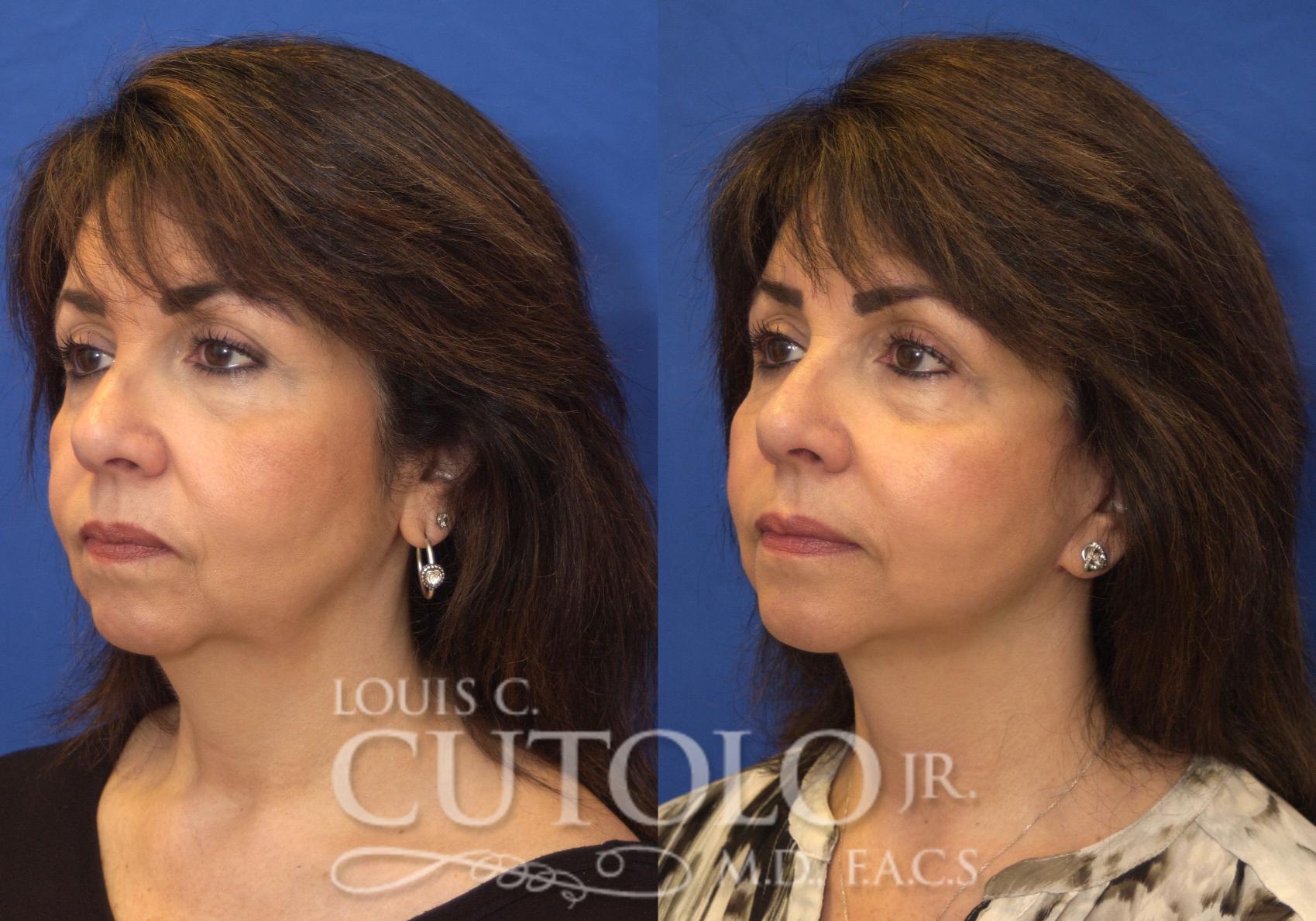 Before & After Rejuvelift™ - Mini Lift Case 215 View #2 View in Brooklyn, Staten Island, Queens, NY