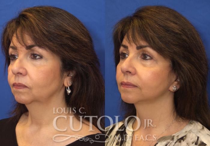 Before & After Rejuvelift™ Case 215 View #2 View in Brooklyn, Staten Island, Queens, NY