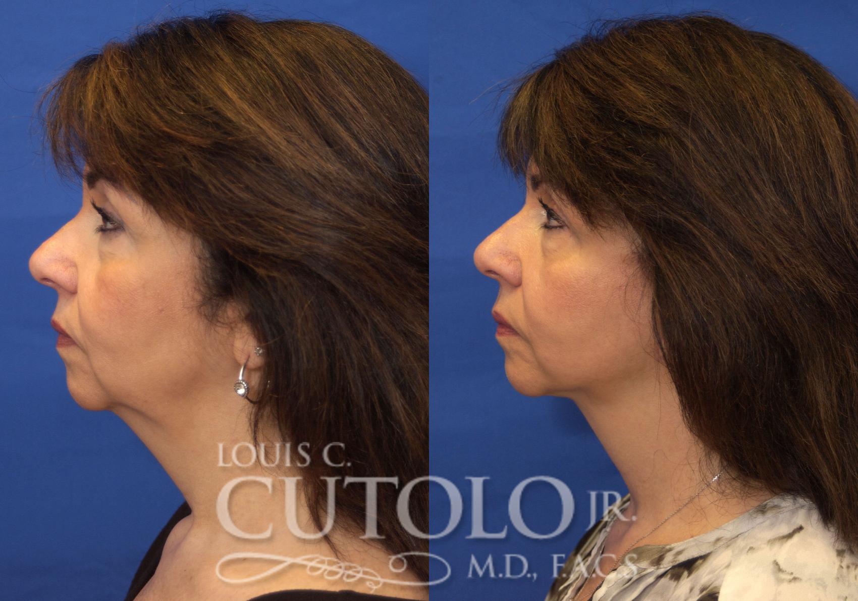 Before & After Rejuvelift™ - Mini Lift Case 215 View #3 View in Brooklyn, Staten Island, Queens, NY