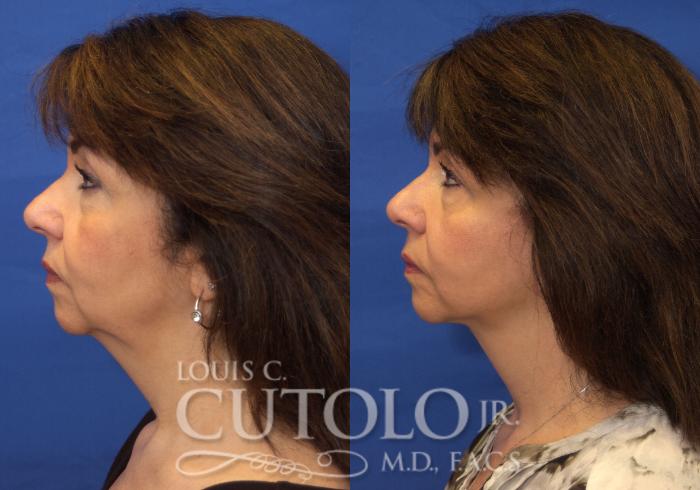 Before & After Rejuvelift™ Case 215 View #3 View in Brooklyn, Staten Island, Queens, NY