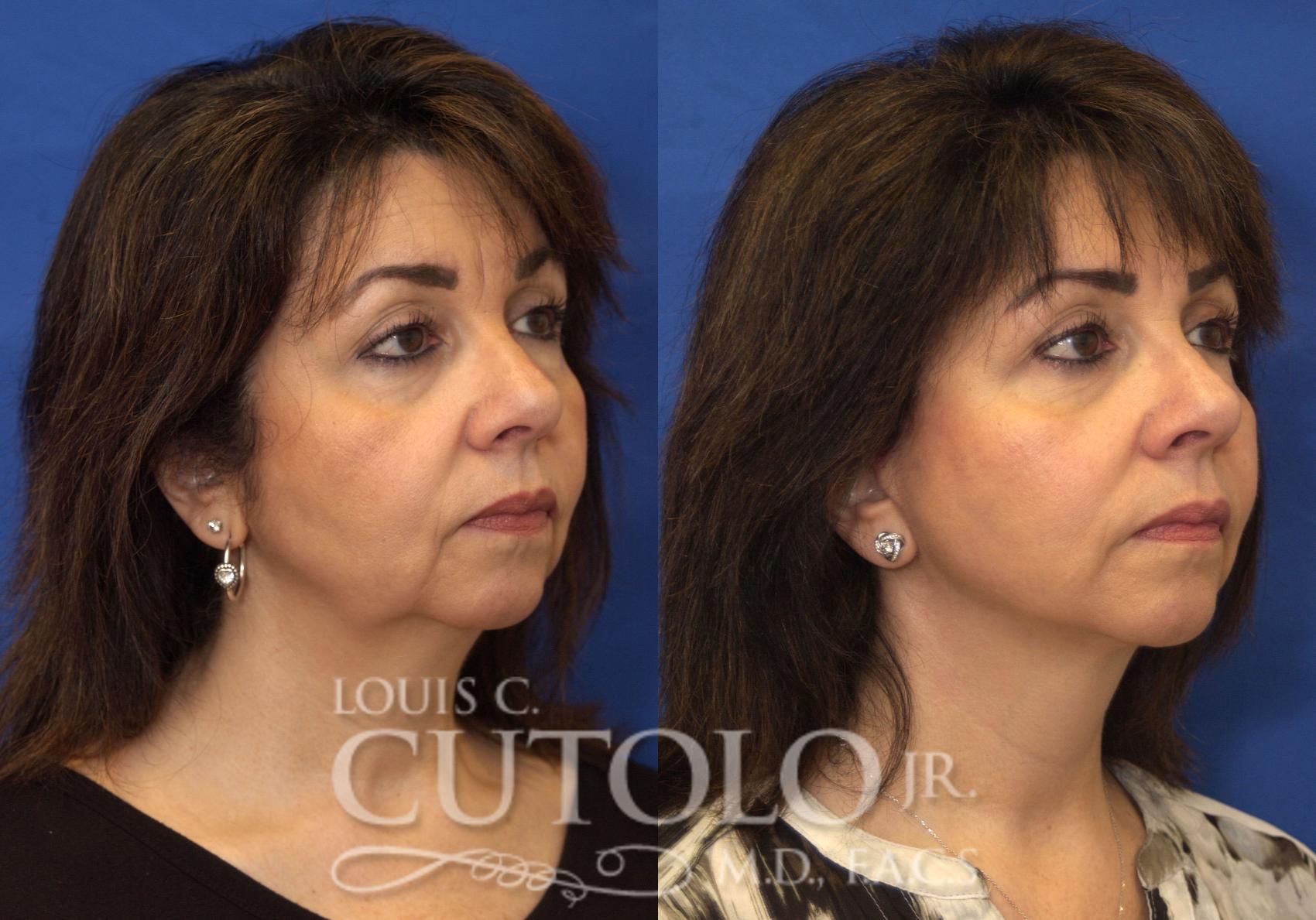 Before & After Rejuvelift™ - Mini Lift Case 215 View #4 View in Brooklyn, Staten Island, Queens, NY