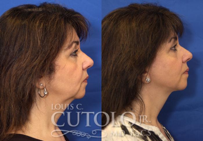 Before & After Rejuvelift™ Case 215 View #5 View in Brooklyn, Staten Island, Queens, NY