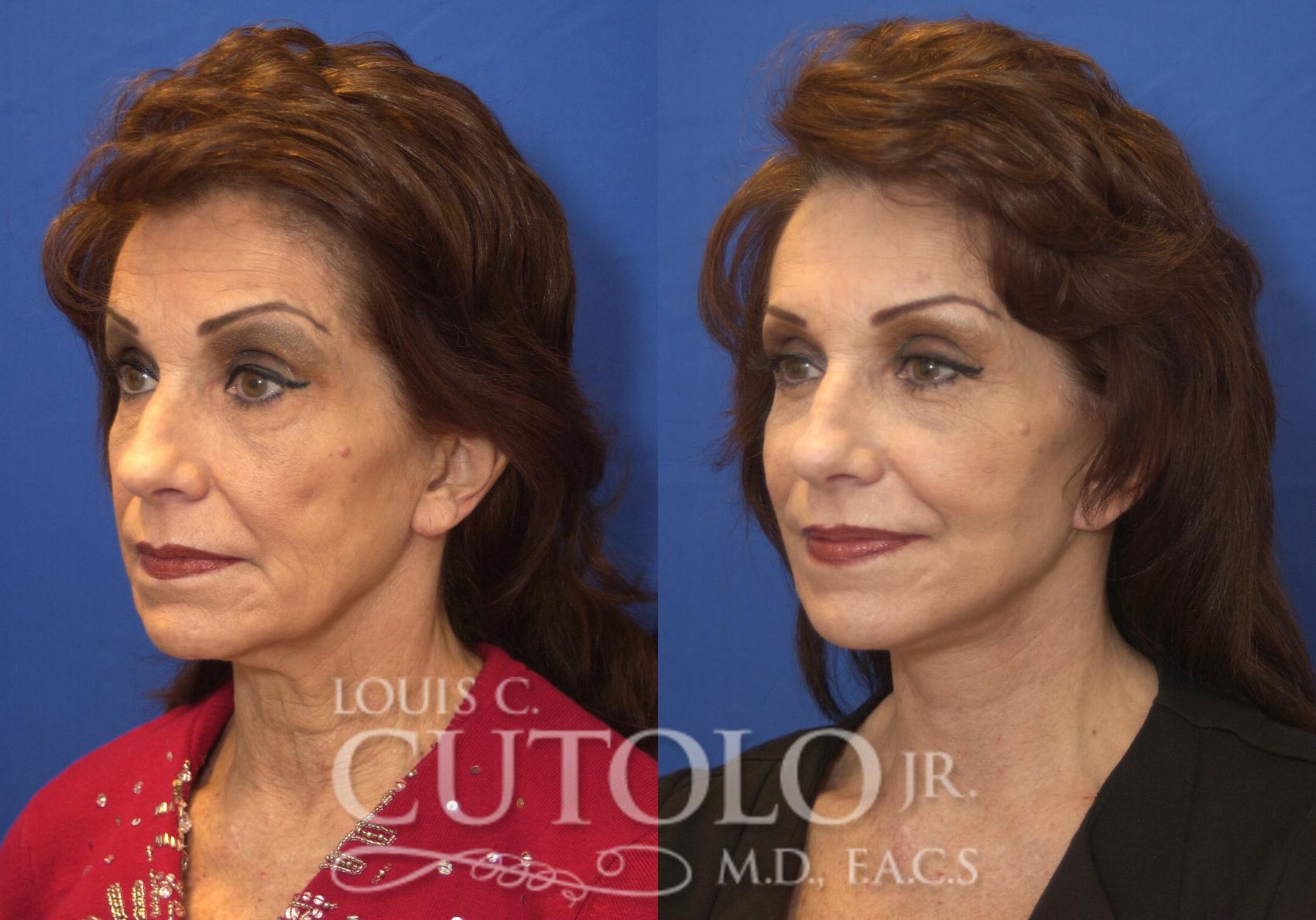 Before & After Rejuvelift™ - Mini Lift Case 218 View #2 View in Brooklyn, Staten Island, Queens, NY