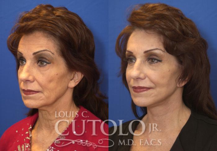 Before & After Rejuvelift™ Case 218 View #2 View in Brooklyn, Staten Island, Queens, NY
