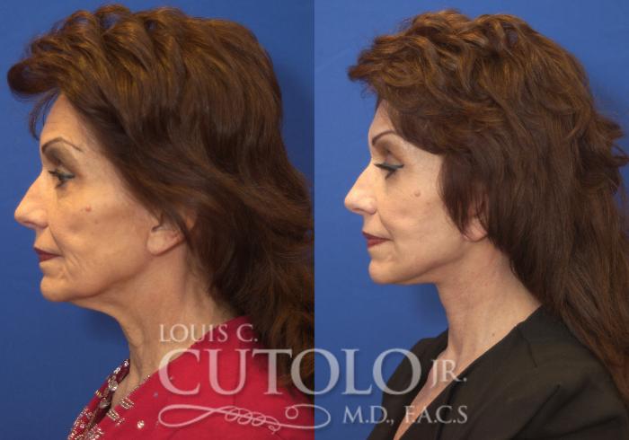 Before & After Rejuvelift™ Case 218 View #3 View in Brooklyn, Staten Island, Queens, NY