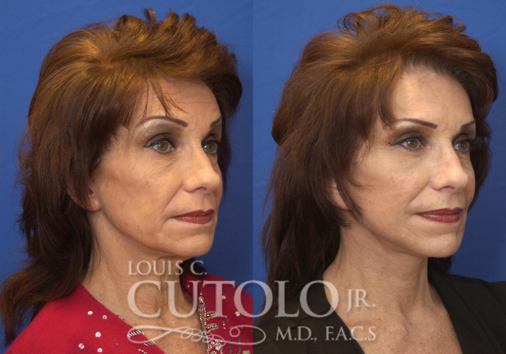Before & After Rejuvelift™ - Mini Lift Case 218 View #4 View in Brooklyn, Staten Island, Queens, NY